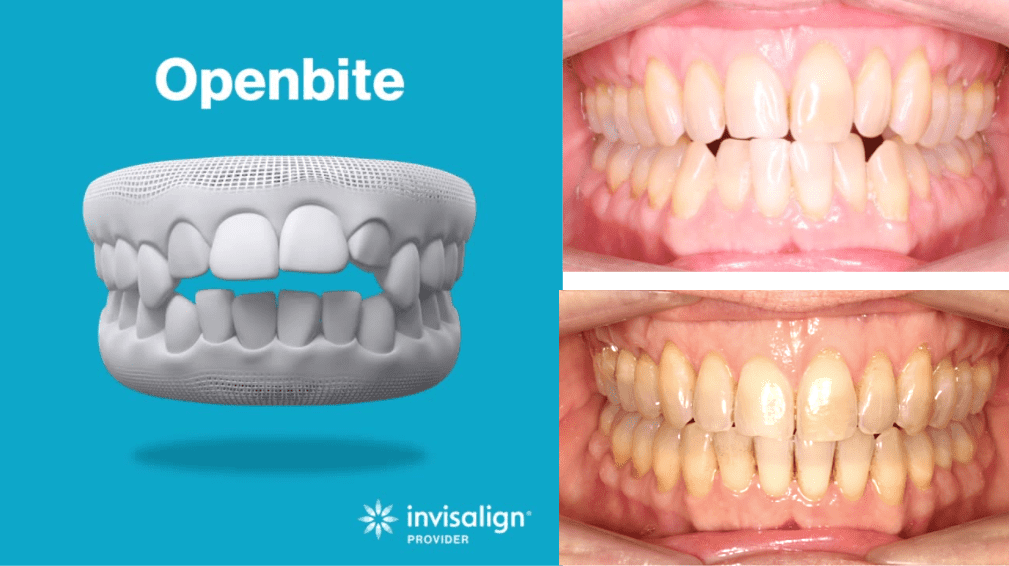 Before & After Invisalign® Clear aligners in Columbia, MD