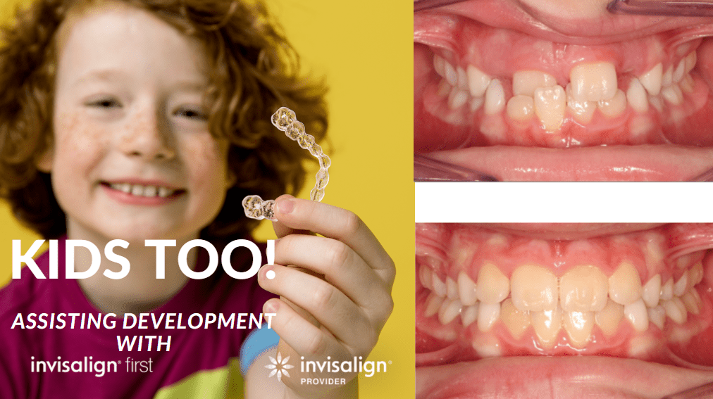 Before & After Invisalign® For Kids in Dr. Jon Moles