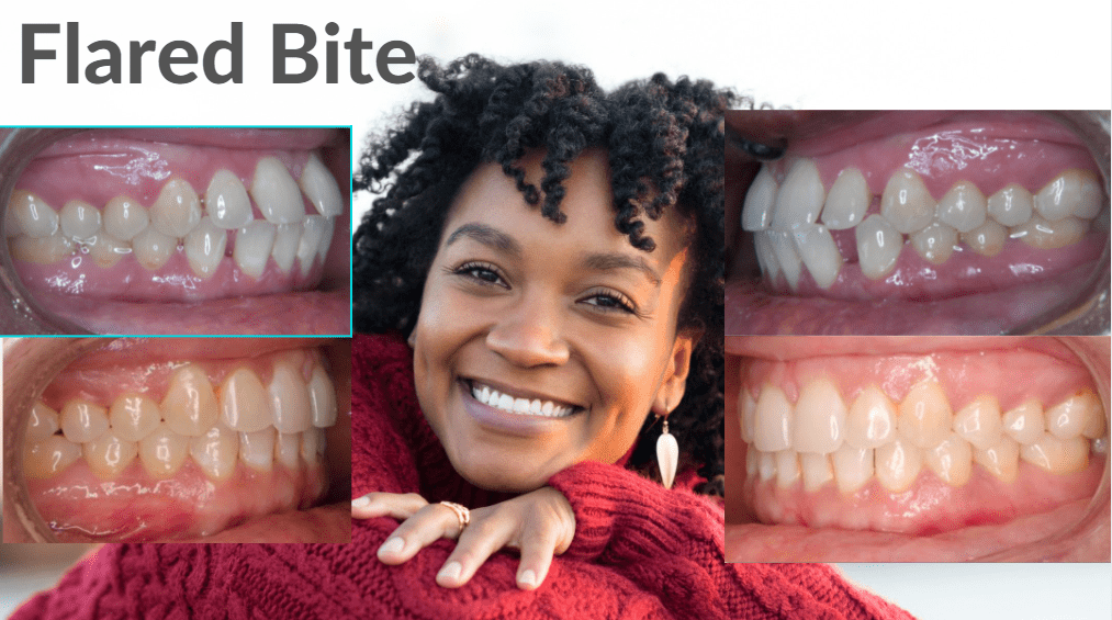 Before & after Invisalign® for adults in Columbia, MD.