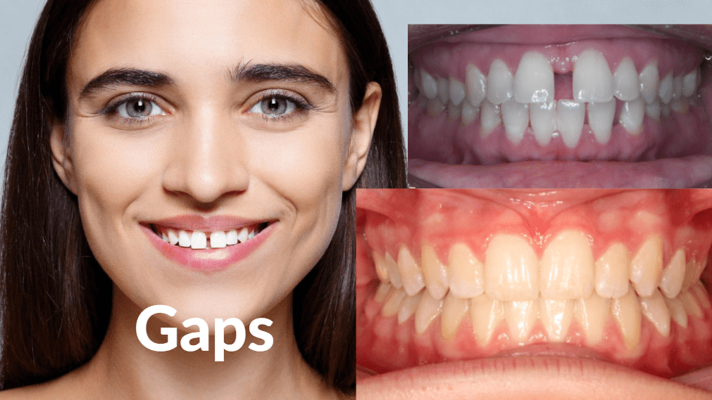 Invisalign® aligning gapped teeth.