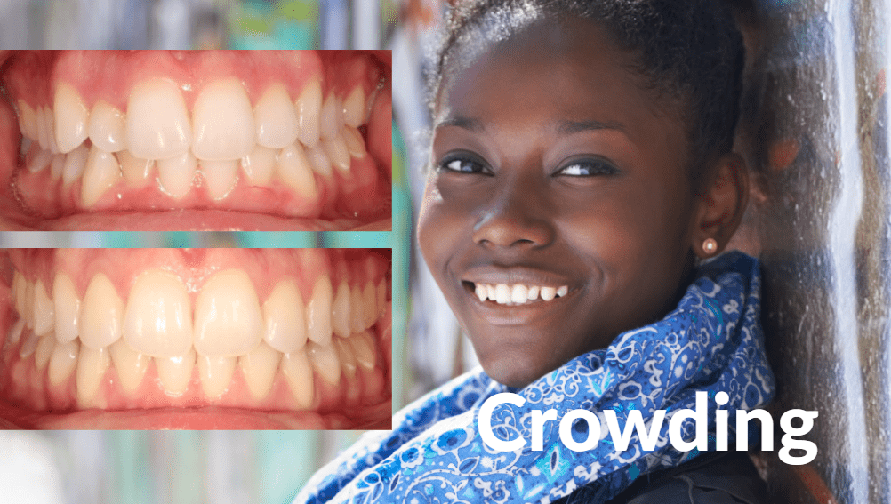 Invisalign® aligning crowded teeth.
