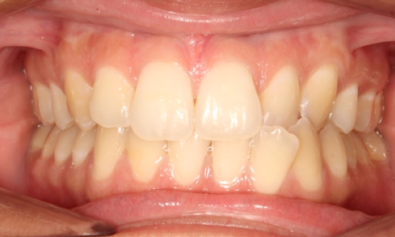 Crossbite Before Invisalign®