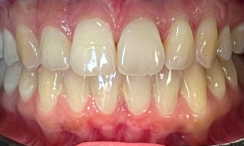 Crossbite After Invisalign® in Columbia, MD